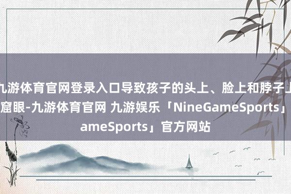 九游体育官网登录入口导致孩子的头上、脸上和脖子上被扎成洞窟眼-九游体育官网 九游娱乐「NineGameSports」官方网站